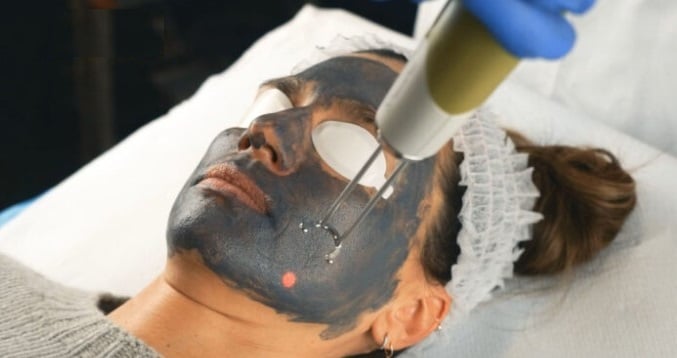 Carbon Peel: el peeling de carbón explicado
